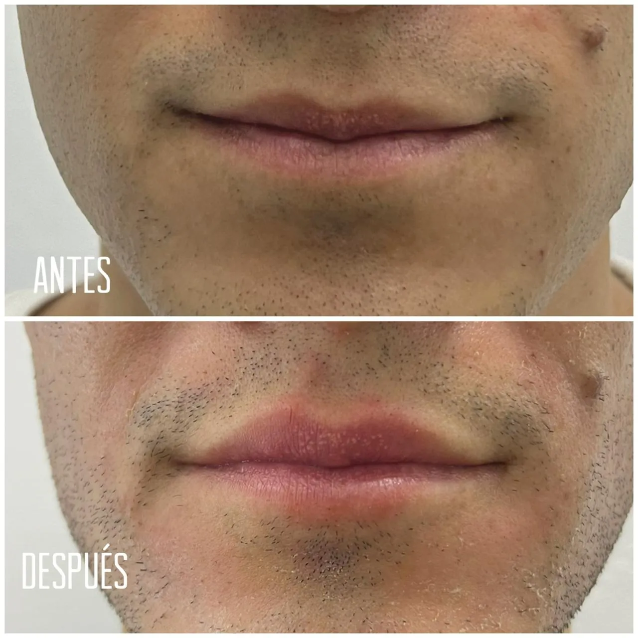 Relleno de labios con ácido hialurónico