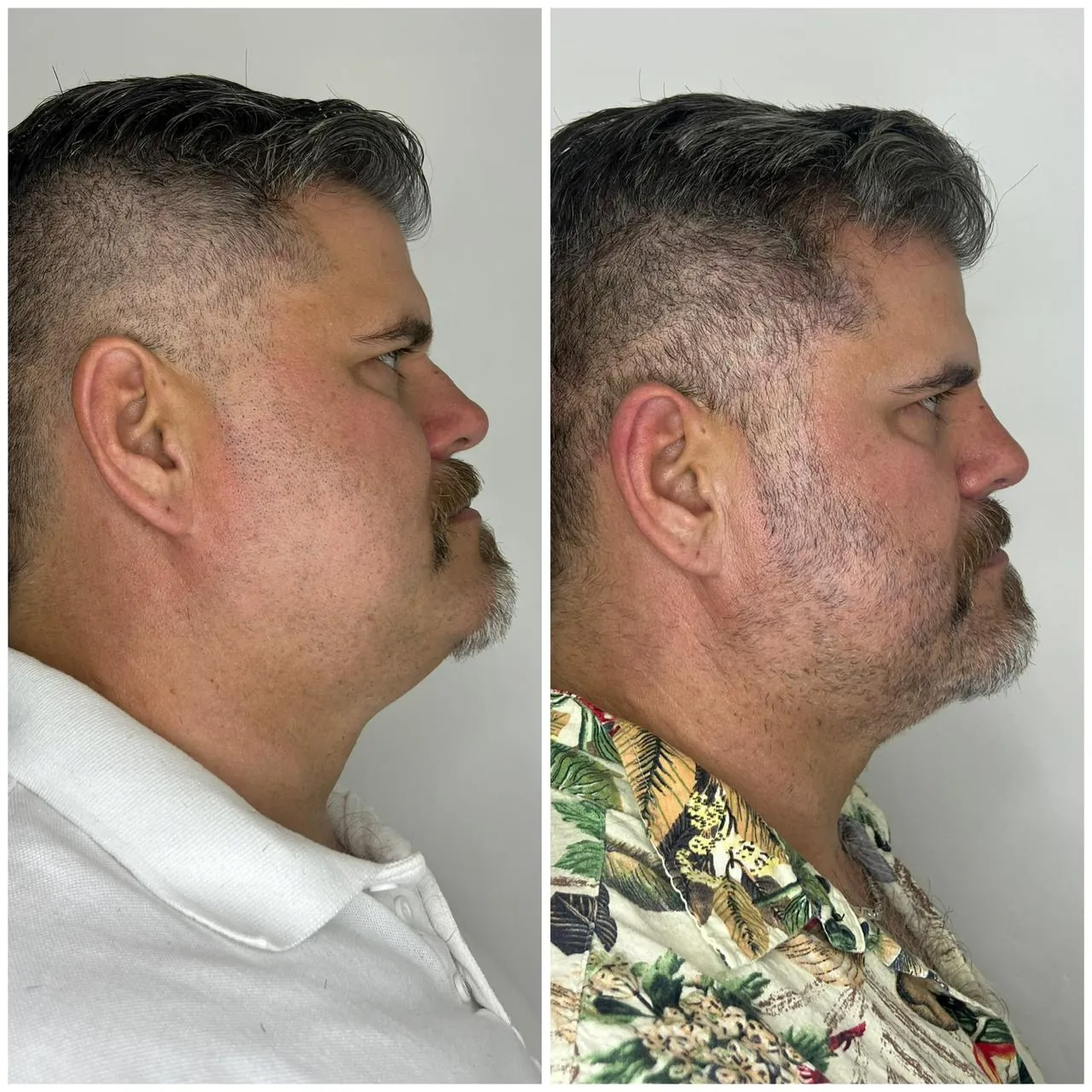 Perfilación mandibular y reducción de papada - Dra. Erika Caballero