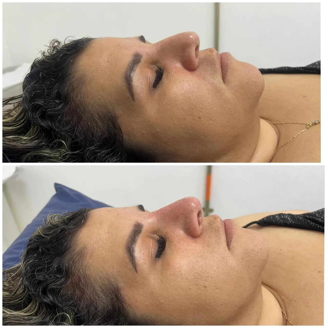 Rinomodelación estética sin cirugía